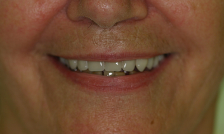 Full-Dentures-in-Santa Monica-WA-After-Image