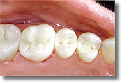 Santa Monica - Los Angeles -  Dental Implant - 